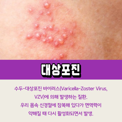 대상포진