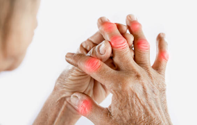 류마티스 관절염