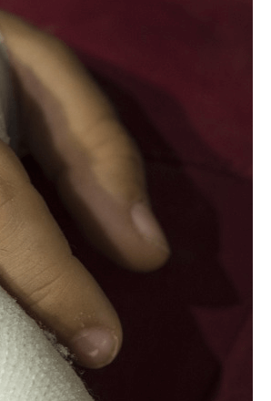 손가락마디통증