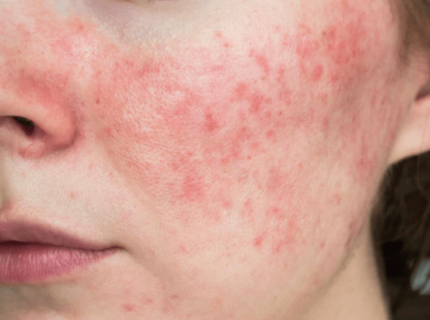 루푸스 진단 및 치료