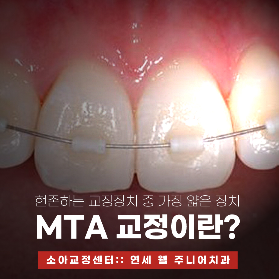 어린이 MTA 교정 미니튜브 장치를 적용한 앞니 교정 모습