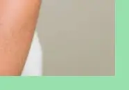 땀띠 원인과 증상 &amp; 치료