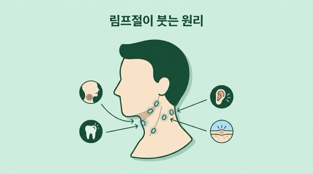 림프절이 붓는 원리 설명 이미지