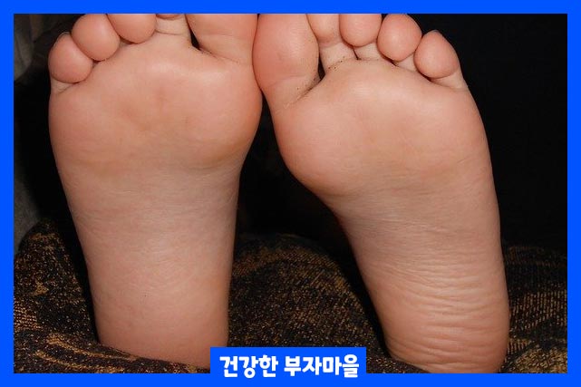선천적 요인 - 평발
