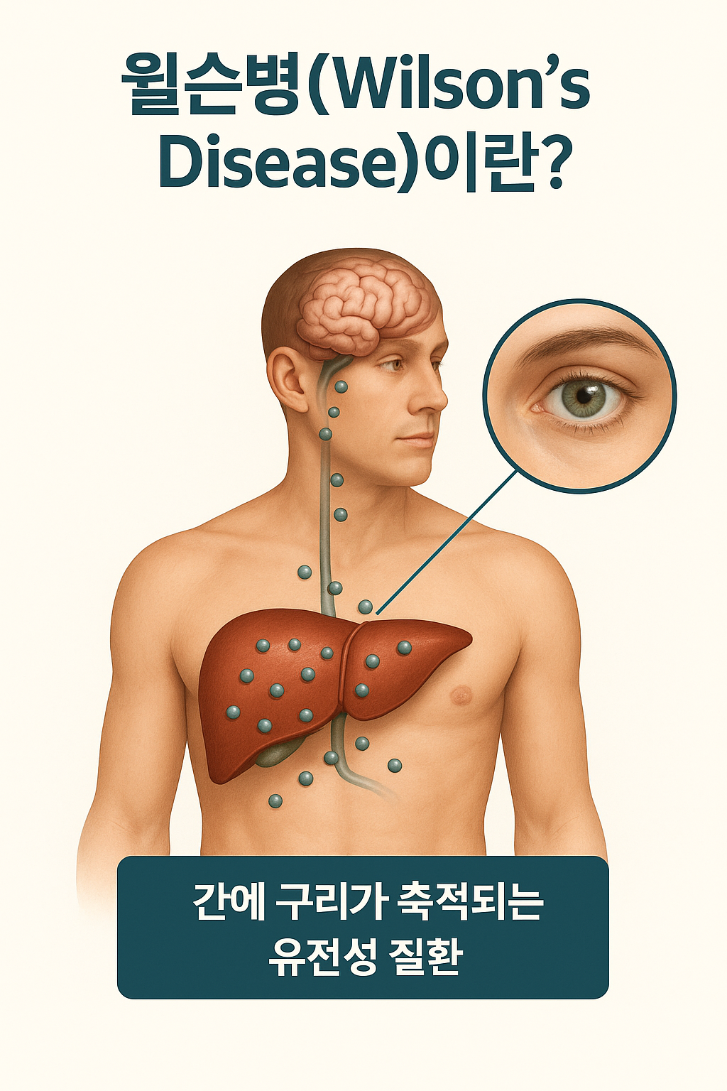 1.윌슨병(Wilson's Disease)