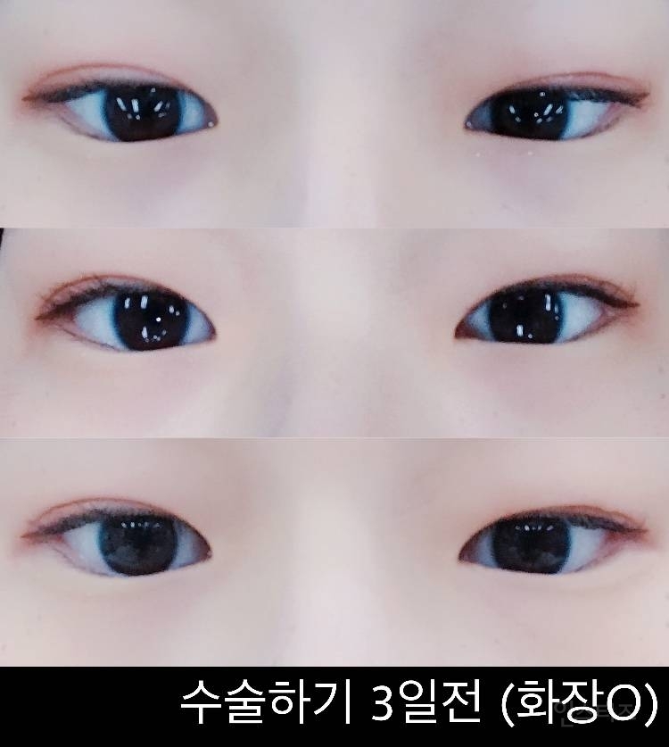 안검내반수술 후기