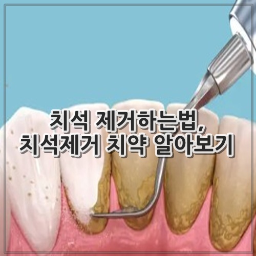 치석 제거하는법, 치석제거 치약 알아보기