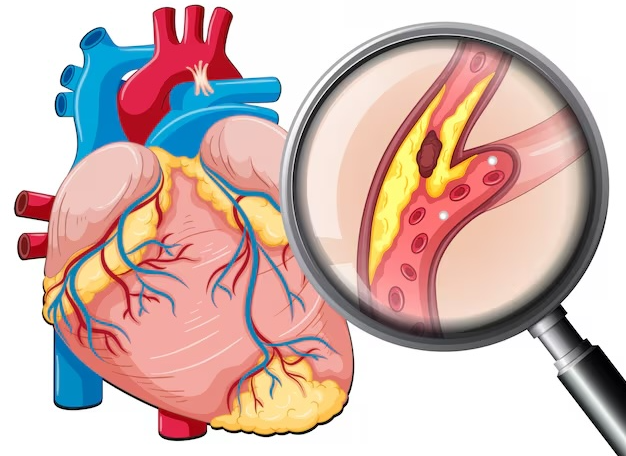 동맥경화증 초기증상 원인