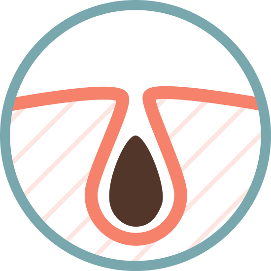 여드름 후유증으로 남은 홍반, 효과적인 관리법은?