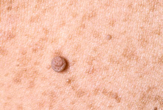 쥐젖_관련_사진