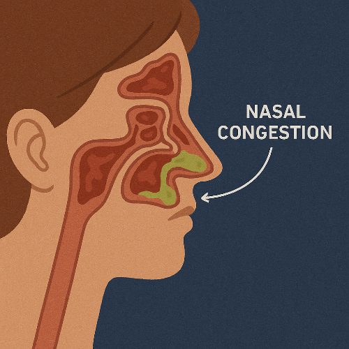 축농증으로 인한 비강 막힘 구조 이미지