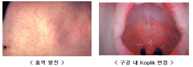 홍역발진 홍역구강내반점