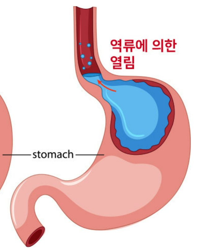 역류성 식도염 증상