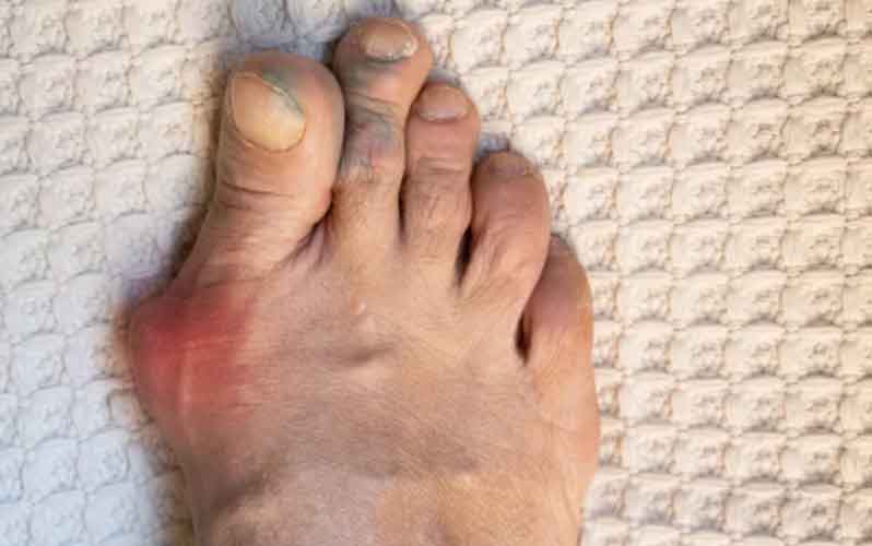 통풍은 뇌졸중·심근경색의 연결고리 예방과 관리