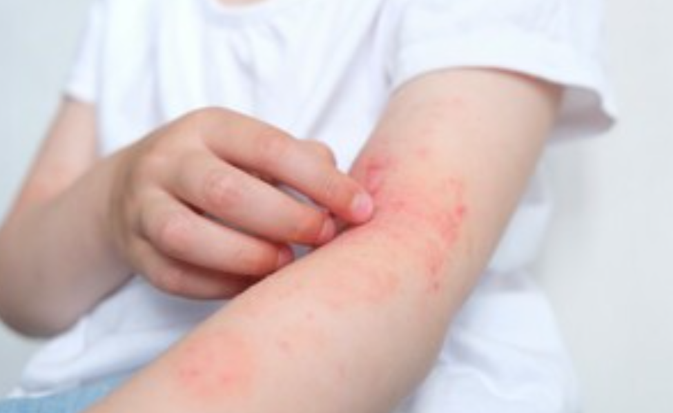 두드러기 예방법