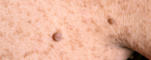 쥐젖 제거 방법 3