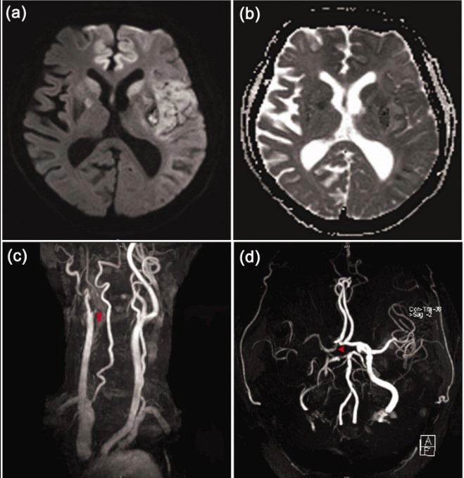 뇌경색 치료방법