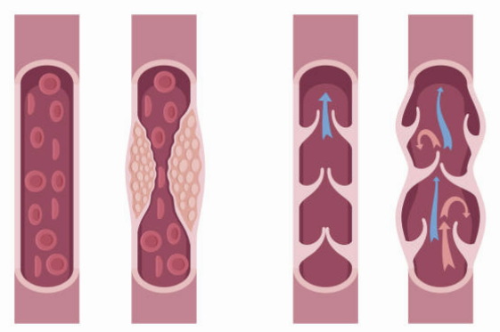 하지정맥류 증상 좋은운동 치료방법 총정리(최신)