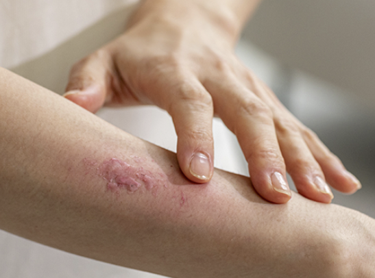 대상포진 초기증상 5가지 총정리 섬네일