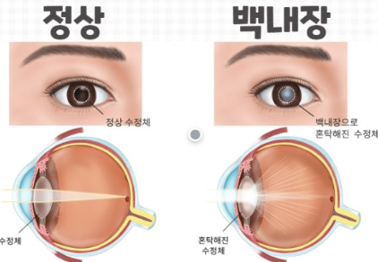 백내장 관련 사진