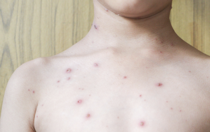 수두 증상 10가지 총정리 섬네일