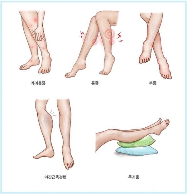 하지정맥류의 초기 증상