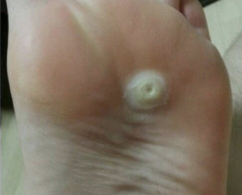 티눈-없애는-방법