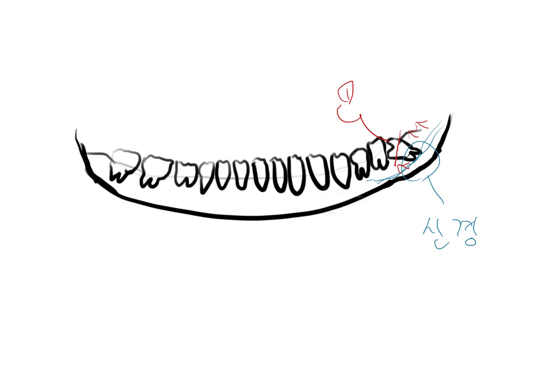 사랑니 발치 과정 그림