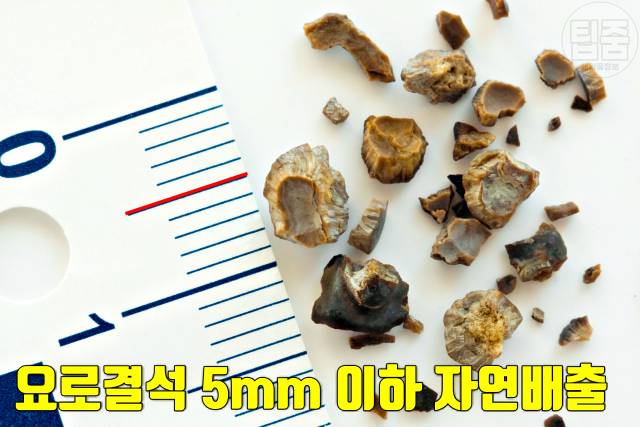 요로결석 증상 요로결석 신장결석 차이 요로결석자연배출