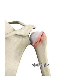 어깨통증원인