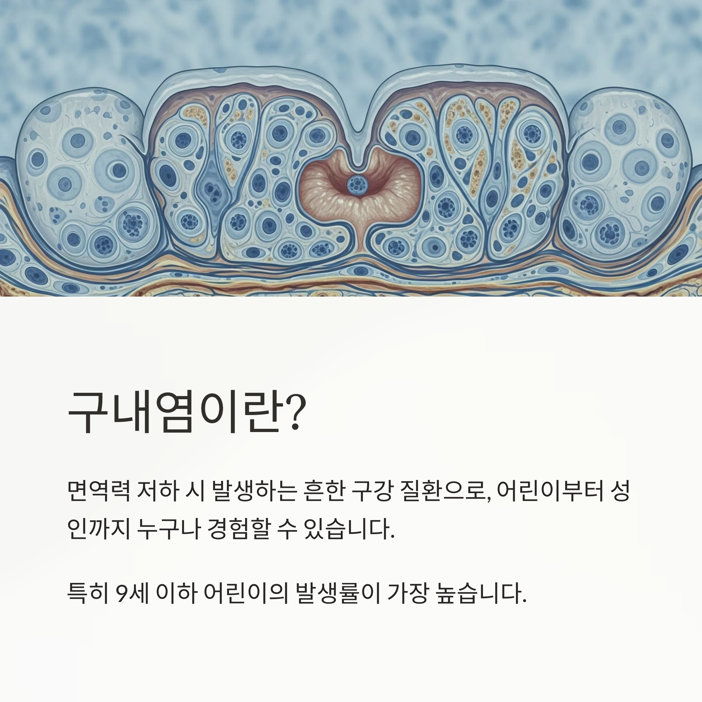 구내염이란?