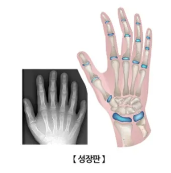 성장판 닫혀도 키 클 수 있는 방법과 성장 호르몬 시기_17