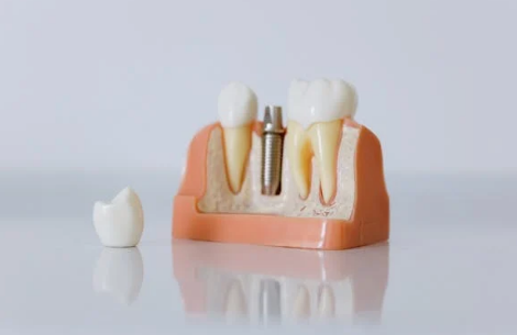 임플란트 종류별 특징 장단점 비교