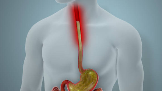 역류성 식도염에 좋은 음식, 증상, 자연치료 방법 총정리 (2024ver)