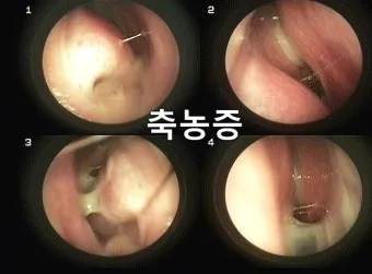 축농증 증상 치료방법 원인 으로_4