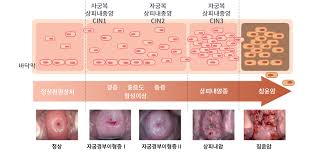 여성질환: 자궁경부암- 예방접종, 검진방법, 증상, 치료방법.