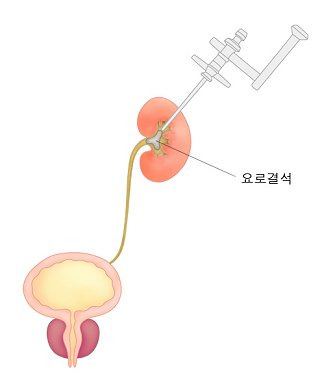 요로결석 증상·원인·치료 -극심한 통증의 원인