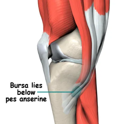 거위발 건염 원인과 증상 무릎 안쪽 통증 치료법 정리_1