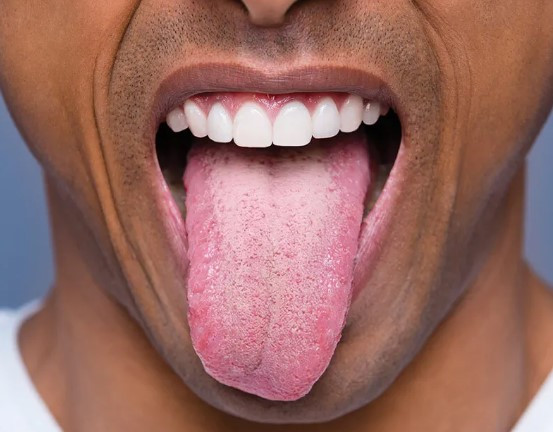 혓바늘 치료제 약 추천