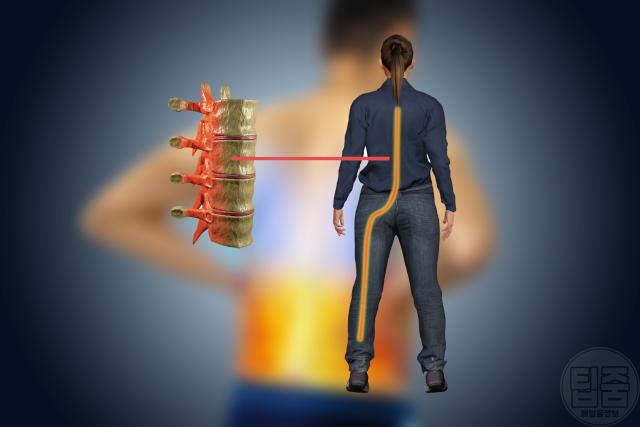 신경 눌림 저림 통증 신경통