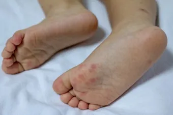 수족구 초기 증상 어른 감염 격리기간 예방 치료 완전 가이드_22