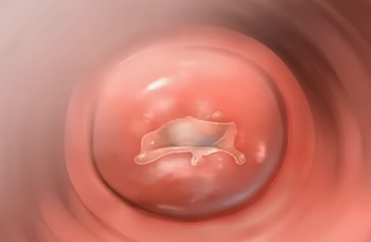 hpv 바이러스 원인