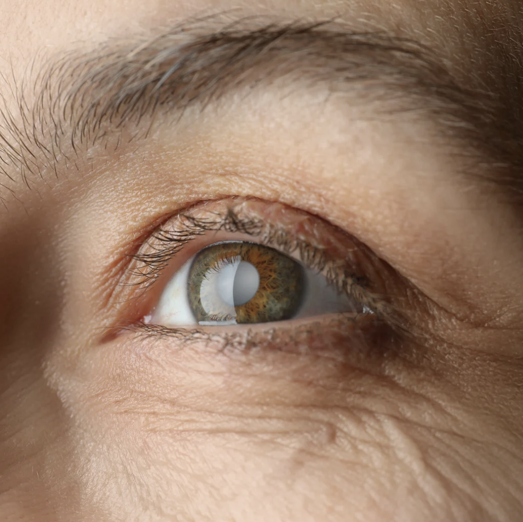 백내장_원인_예방_종류_수술