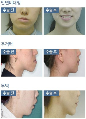수술 전 후