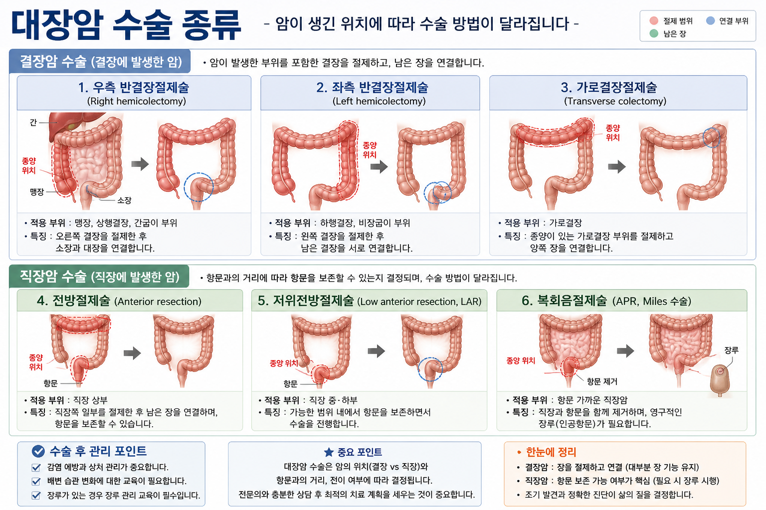 우측 반결장절제술, 좌측 반결장절제술, 전방절제술, 복회음절제술 등 대장암 수술 방법을 설명한 이미지