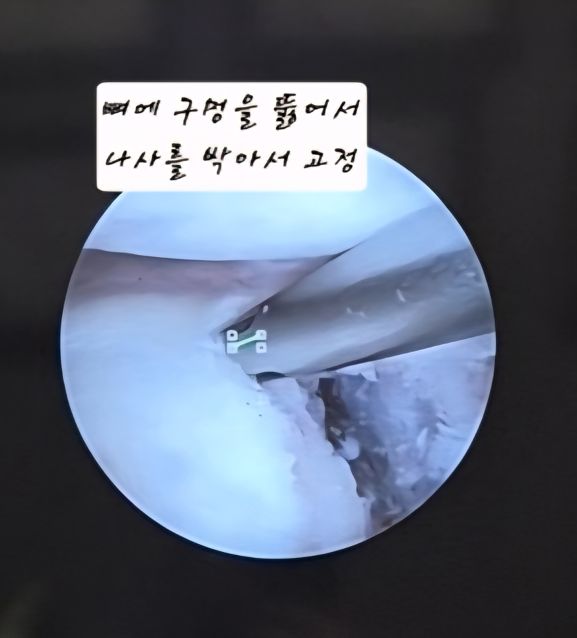 어깨 와순파열 봉합수술 후 mri사진 물리치료 기록