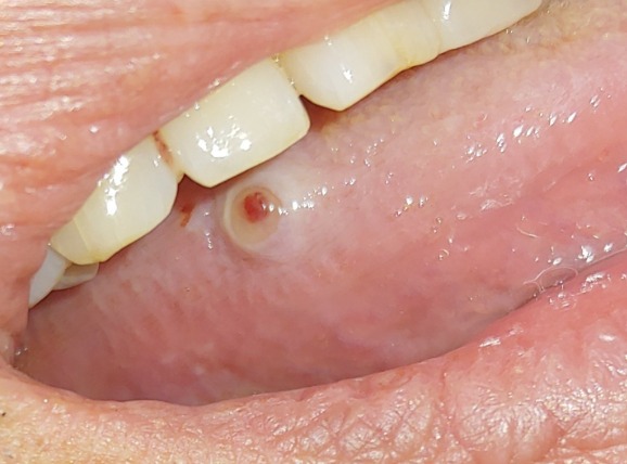 설암(혀암) 초기증상과 원인