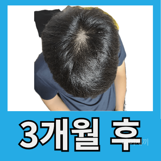"탈모약 3개월 후"