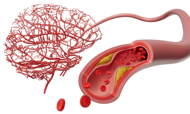 알츠하이머·파킨슨·혈관성 치매 차이점 총정리 + 증상 체크리스트