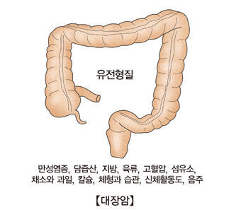 대장암 초기증상